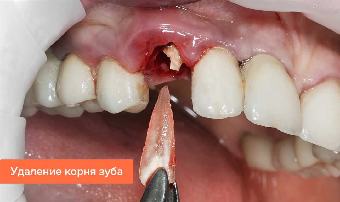 Зубы человека удаление