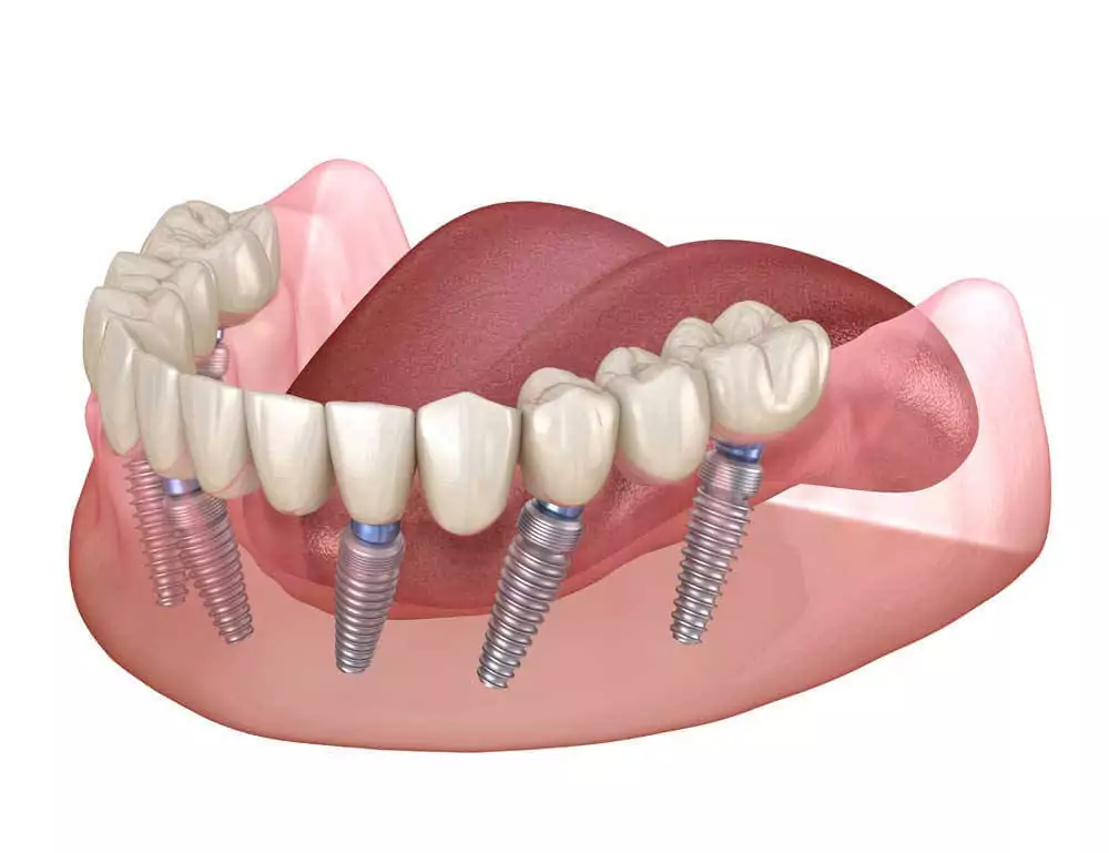 Что такое имплантация зубов