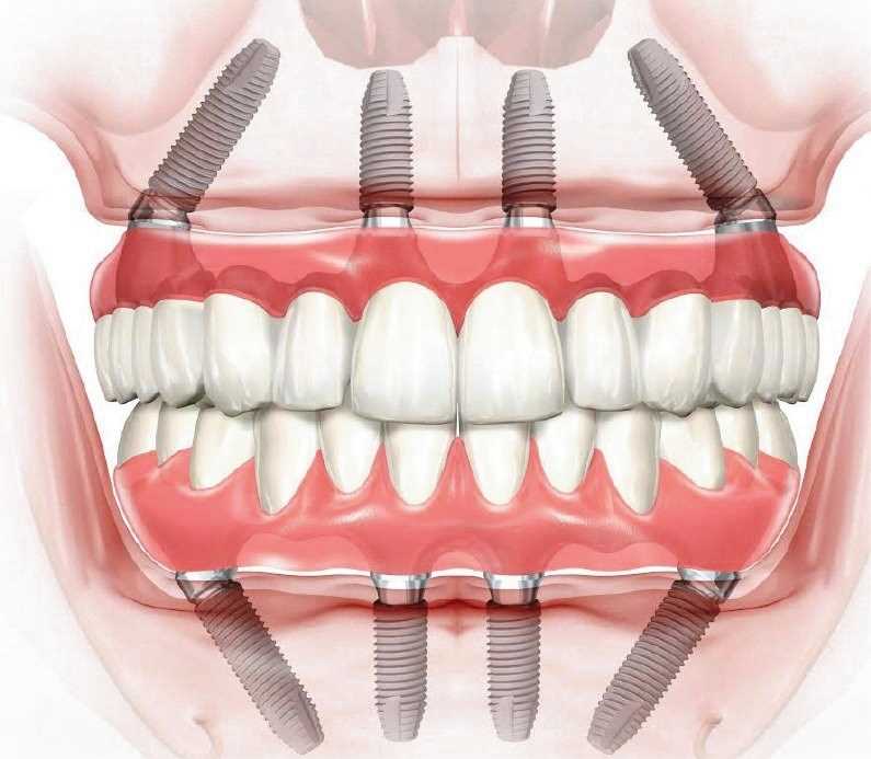 Зубы имплантация или протезирование