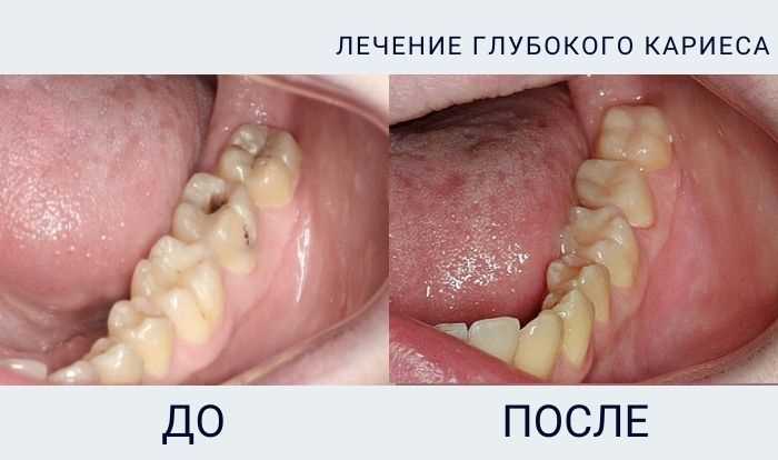 Типы зубной боли