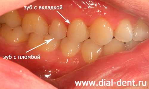 Почему болит зуб после лечения кариеса