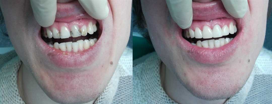 Зубы после лечения кариеса