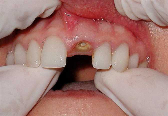 Почему зубы смещаются
