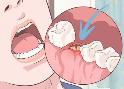 Зубы после удаления соседних зубов