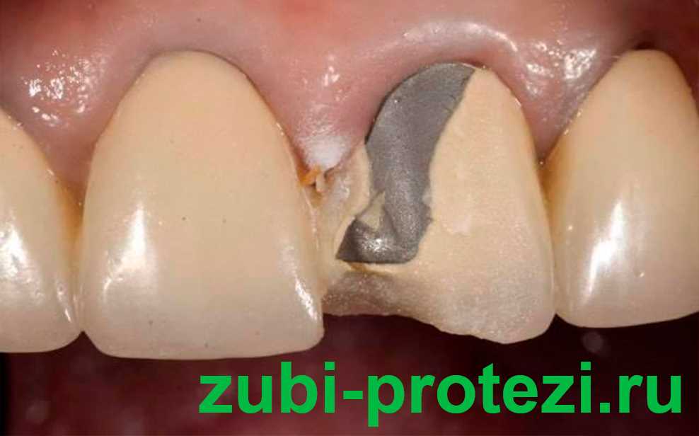 Зубы ремонт протезирование зубов