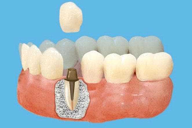 Зубной мост на 1 зуб