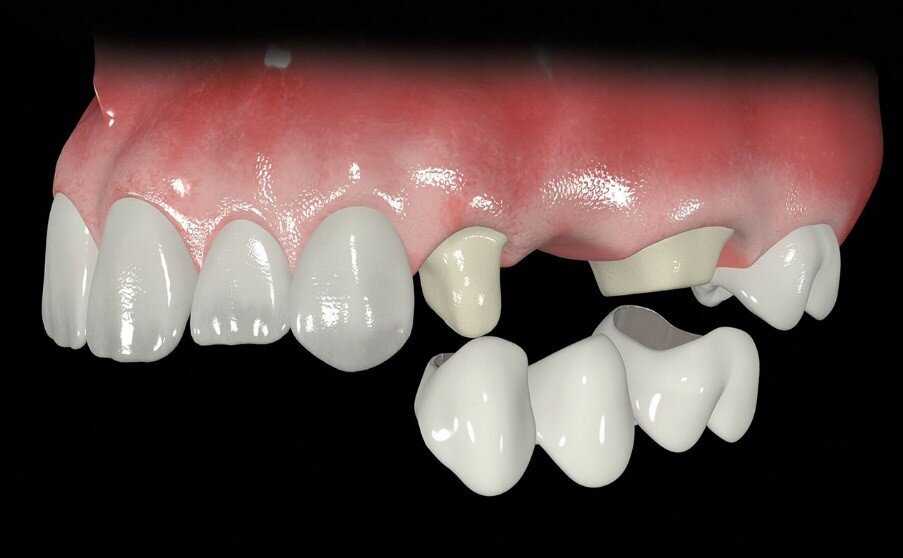 Комфорт и эстетика – консольные протезы зубов в клинике Iceberg