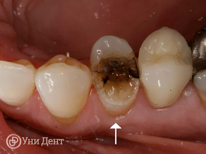 Как ставят коронку на зуб