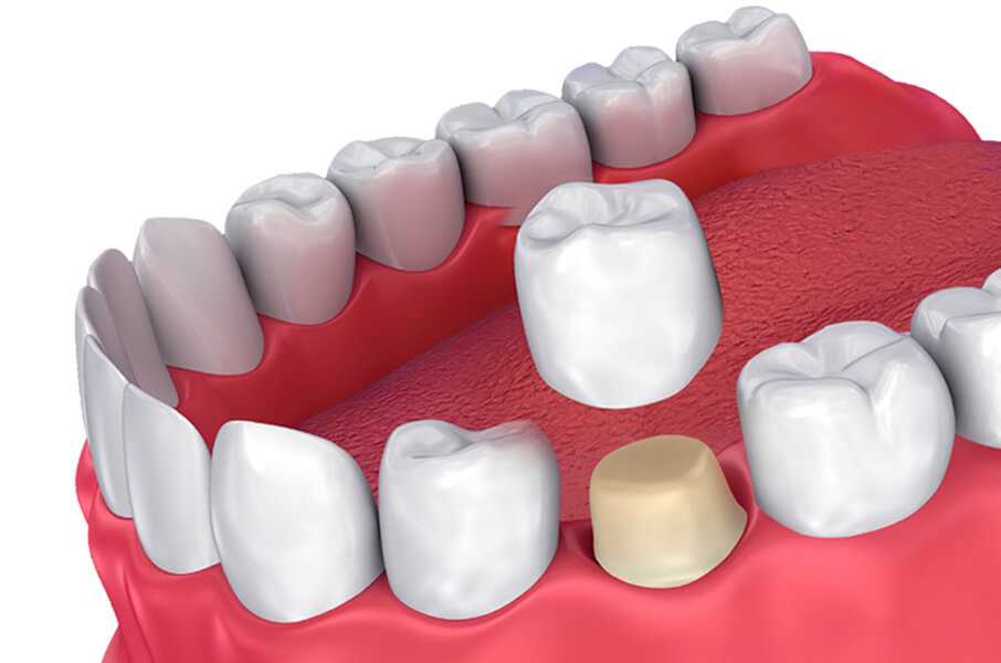 Превосходная зубная коронка окисления — эффективное и долговечное решение для восстановления зубного ряда
