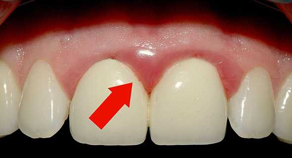Зубные коронки — причины боли, способы предотвращения и лечения.