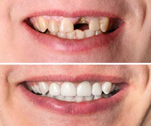 Как изменятся ваша улыбка и зубы после установки зубных коронок — процесс, результаты и рекомендации