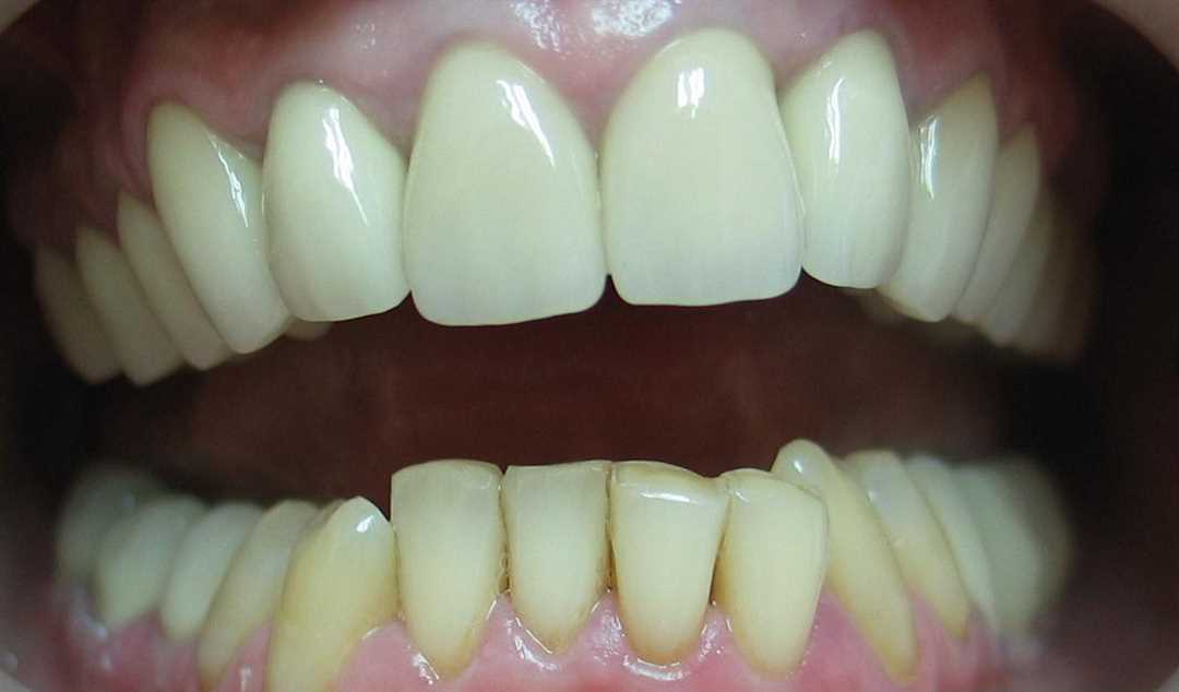 Какие преимущества и недостатки имеют зубные коронки из металлопластмассы?