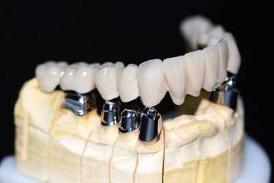 Сколько стоит изготовить зубную коронку на имплант в клинике ROOTT