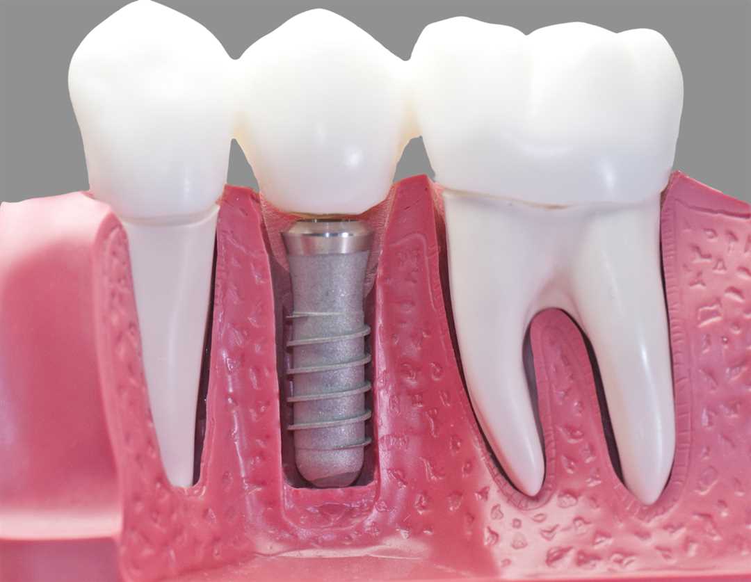 Коронка на имплант или на обточенный зуб – что лучше?