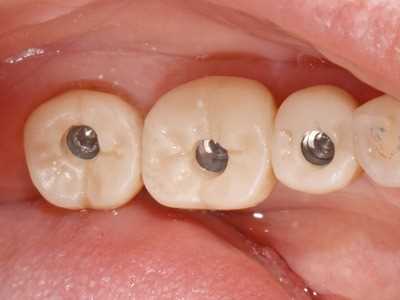 Выбор и нанесение зубных коронок на импланты — современные технологии и тренды
