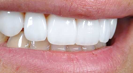 Металлокерамические коронки на зубы: плюсы и минусы