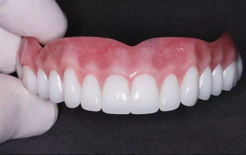 Этапы протезирования зубов безметалловыми коронками