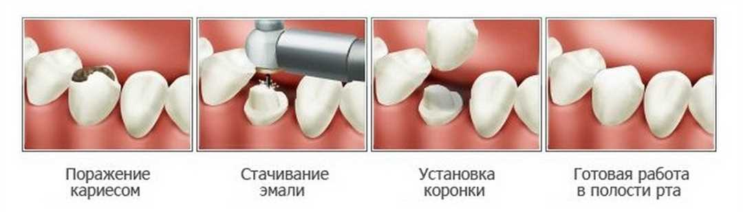 Зубные коронки противопоказания