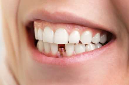 Сколько стоит изготовление коронки на зуб в клинике ROOTT