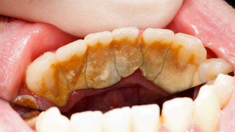 Поддесневые зубные отложения