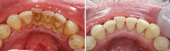 Зубные отложения: виды, вред, способы удаления