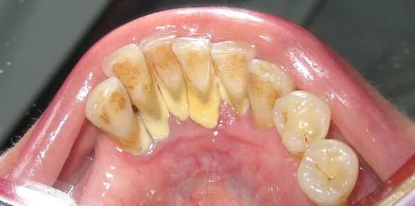 Особенности зубных отложений