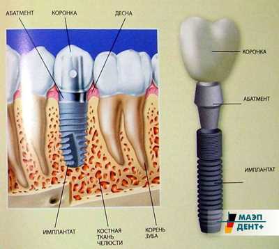 Зубной имплант без коронки