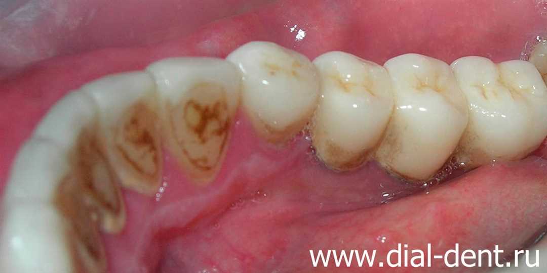 Зачем нужна профилактика и удаление зубного камня?
