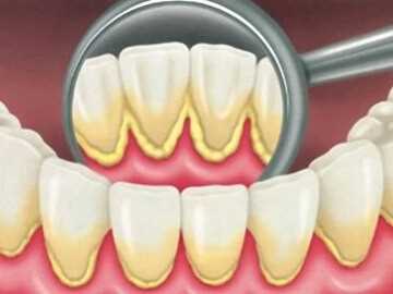 Что такое зубной налёт? По каким причинам он скапливается?