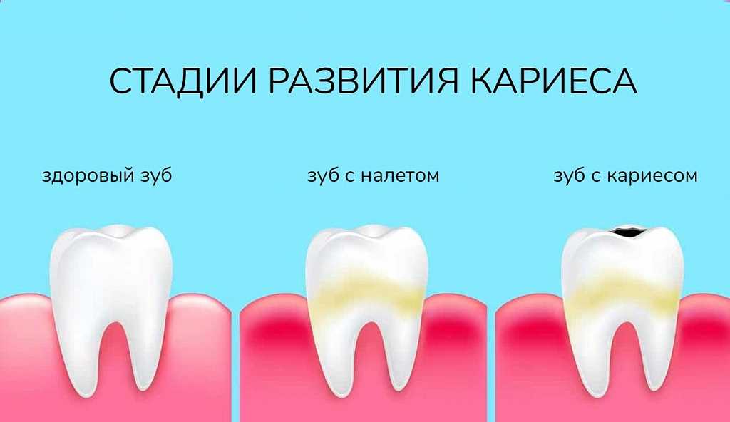 Зубной налет: профилактика и лечение