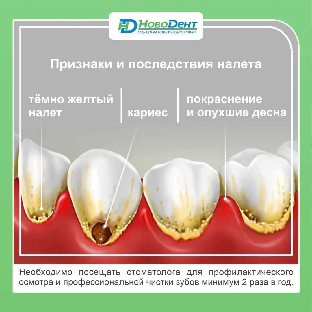 Зубной налет и кариес