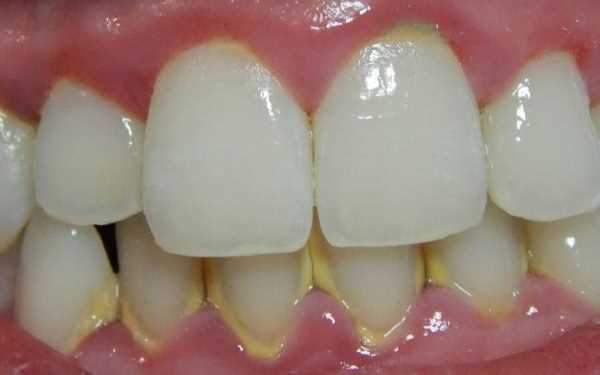 Отличия зубного камня от зубного налета
