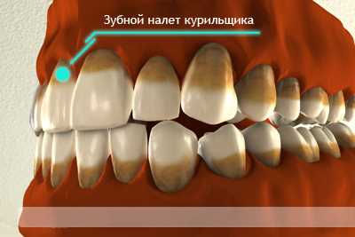 Зубной налет курильщика — причины, последствия и способы предотвращения