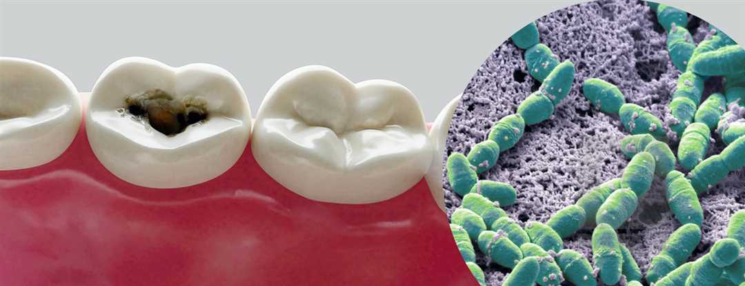 Другие способы предотвращения развития зубного налета