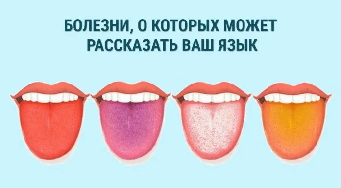 Влияние зубного налета на языке на здоровье полости рта и организма в целом — причины образования, последствия и методы предотвращения