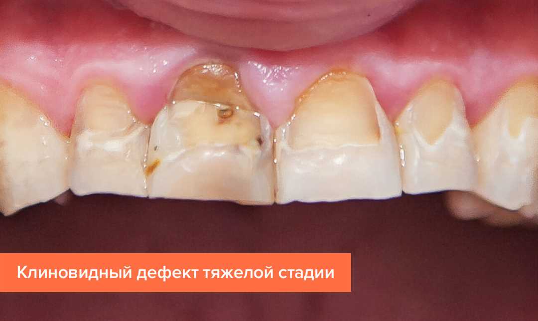 K00-K14 Болезни полости рта, слюнных желез и челюстей. V. 2016