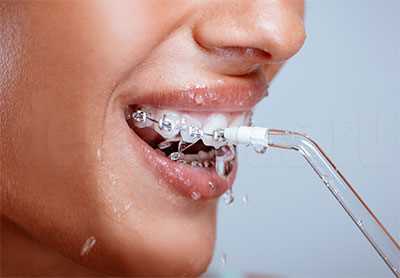 Правильный уход за полостью рта и брекет-системой