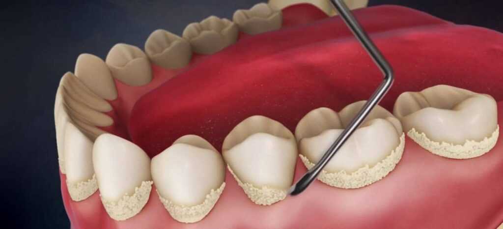 Как избавиться от зубного налета в домашних условиях без посещения стоматолога