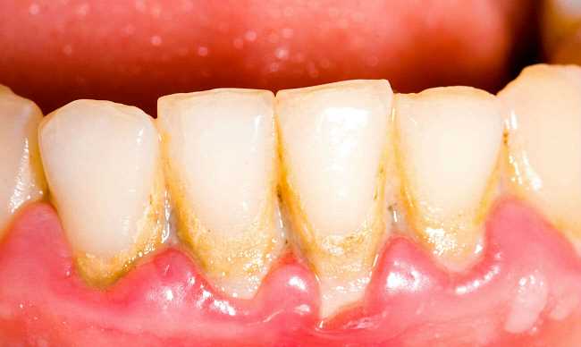 Патологические зубные отложения